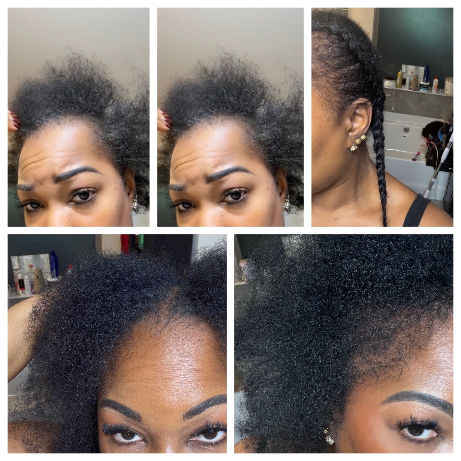 Scalp hair regrowth progress before and after